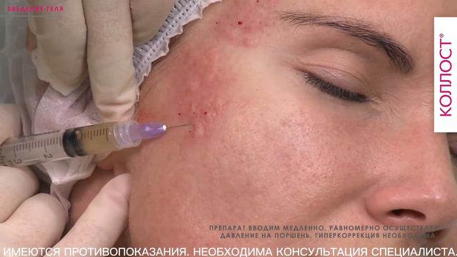 МАСТЕР-КЛАСС «Коррекция атрофических рубцов на лице с помощью коллагенового комплекса КОЛЛОСТ®»