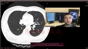 Перелом лопатки. Ролик №49