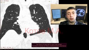 ТЭЛА. Тромбоэмболия легочной артерии. Ролик №45