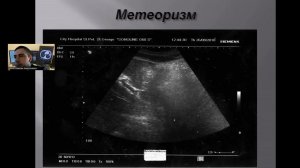 К вопросу об УЗ-диагностике острого панкреатита