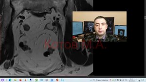 Дивертикулез тонкой кишки на МРТ. Ролик №14.