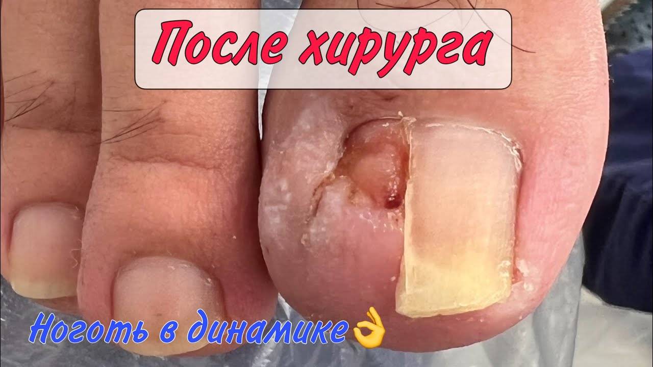 Ноготь после хирурга _ вросший ноготь _ подолог в москве