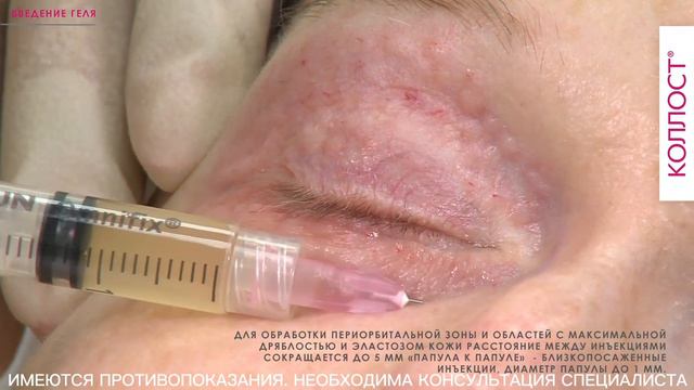 МАСТЕР-КЛАСС «Коррекция возрастных изменений лица и шеи с помощью коллагенового комплекса КОЛЛОСТ®»