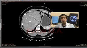 Киста брызжейки кишечника. Ролик №40