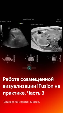 Совмещенная визуализация iFusion на практике. Часть 3