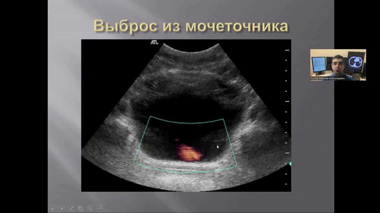 Ультразвуковая анатомия мочевого пузыря.