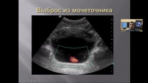 Ультразвуковая анатомия мочевого пузыря.
