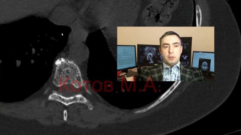 Миеломная болезнь. Ролик №17.