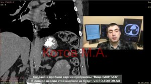 Липома 12 ти перстной кишки. Ролик №32