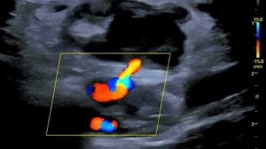 Ложная аневризма поверхностной бедренной артерии