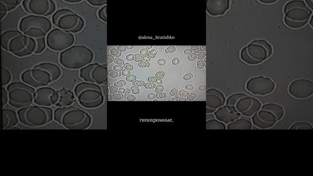 Аутизм у детей. Клетки крови под микроскопом