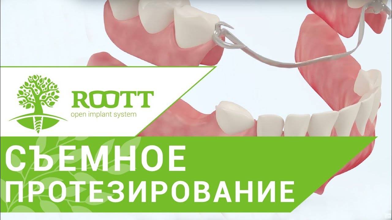 Виды съемных зубных протезов. 👵 Различные способы крепления и виды съемных зубных протезов.