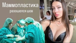 Маммопластика Спустя Год | Питер-Моска | Разошелся Шов