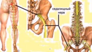 ИШИАС - НЕВРАЛГИЯ СЕДАЛИЩНОГО НЕРВА. Эффективное лечение. Метод гирудотерапии - лечение медицинскими