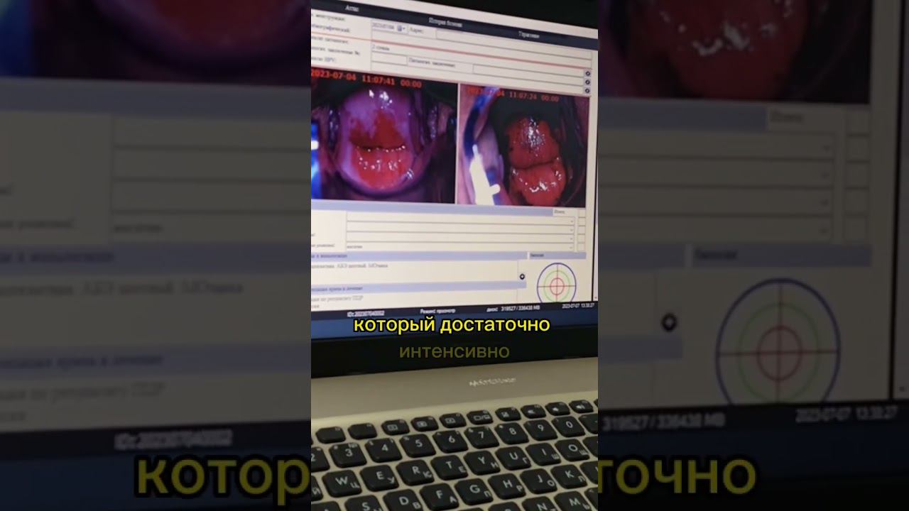 ✨Кандидат медицинских наук- Зарема Меджидовна при кольпоскопии обнаружила предрак