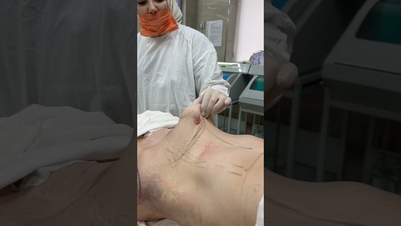 Липоабдоминопластика. Работа пластического хирурга -Муминат Ахмедовны , профессионала своего дела