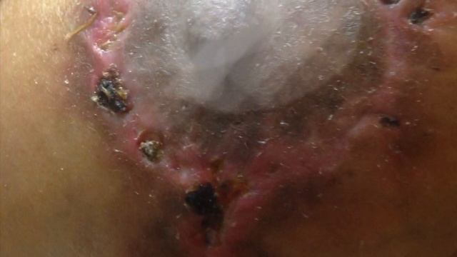 Breast implant story: Dr. Adam Rubenstein butcher of Miami horrible bad work, Complications, SCARS