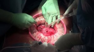 Cesarean Section featuring the Alexis® O C-Section Retractor