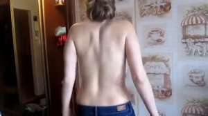 СКОЛИОЗ