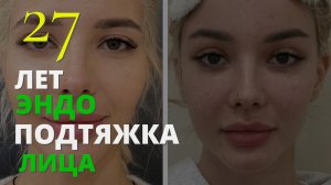 Подтяжка лица в 27 лет???! Не спешите с осуждением! Посмотрите на результат...