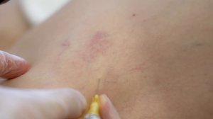 Как удалить вены на ногах? Секреты операции по удалению вен