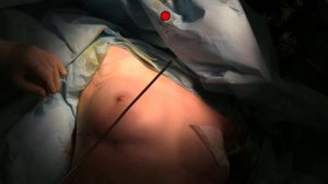 «Повторная установка экспандера при отсроченной реконструкции МЖ с одномоментным липофилингом»