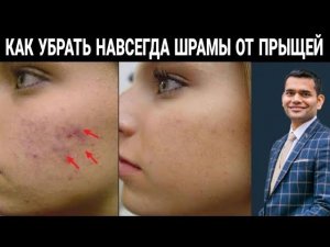 Следы От Прыщей Затягиваются Очень Быстро?