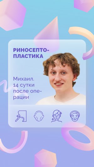 Михаил. Риносептопластика. 14 сутки после операции