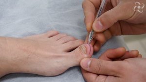 Удаление подногтевого экзостоза