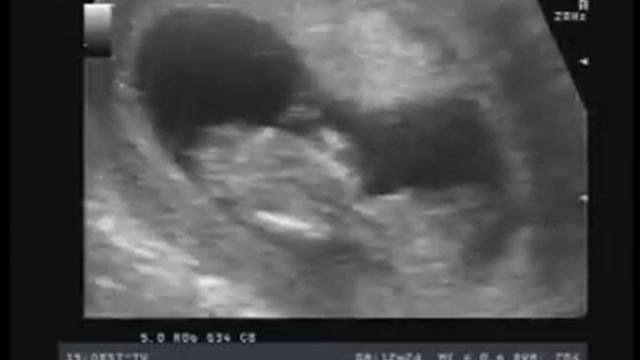 УЗИ 12 недель наш любимый малыш!!! смотреть онлайн