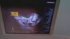 УЗИ-22 НЕДЕЛИ,ДЕВОЧКА!!