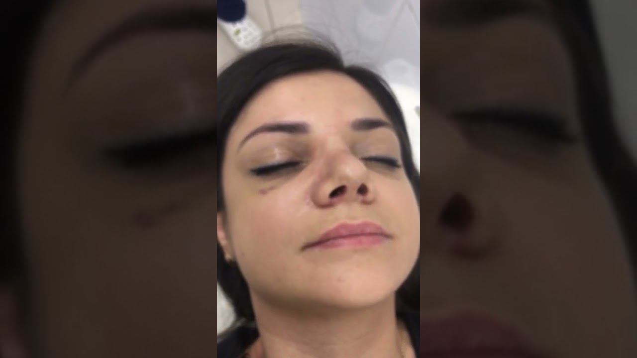 Снятие лангеты после ринопластики. Часть 2. Хирург А.А.Григорян смотреть онлайн