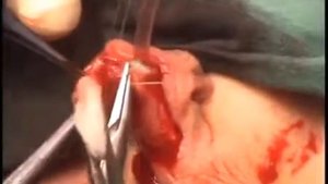 Гипоспадия, оперативное лечение гипоспадии ( дистальная гипоспадия)