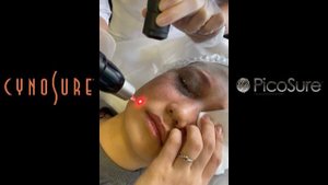 Удаление Невуса Ота на лазере PicoSure