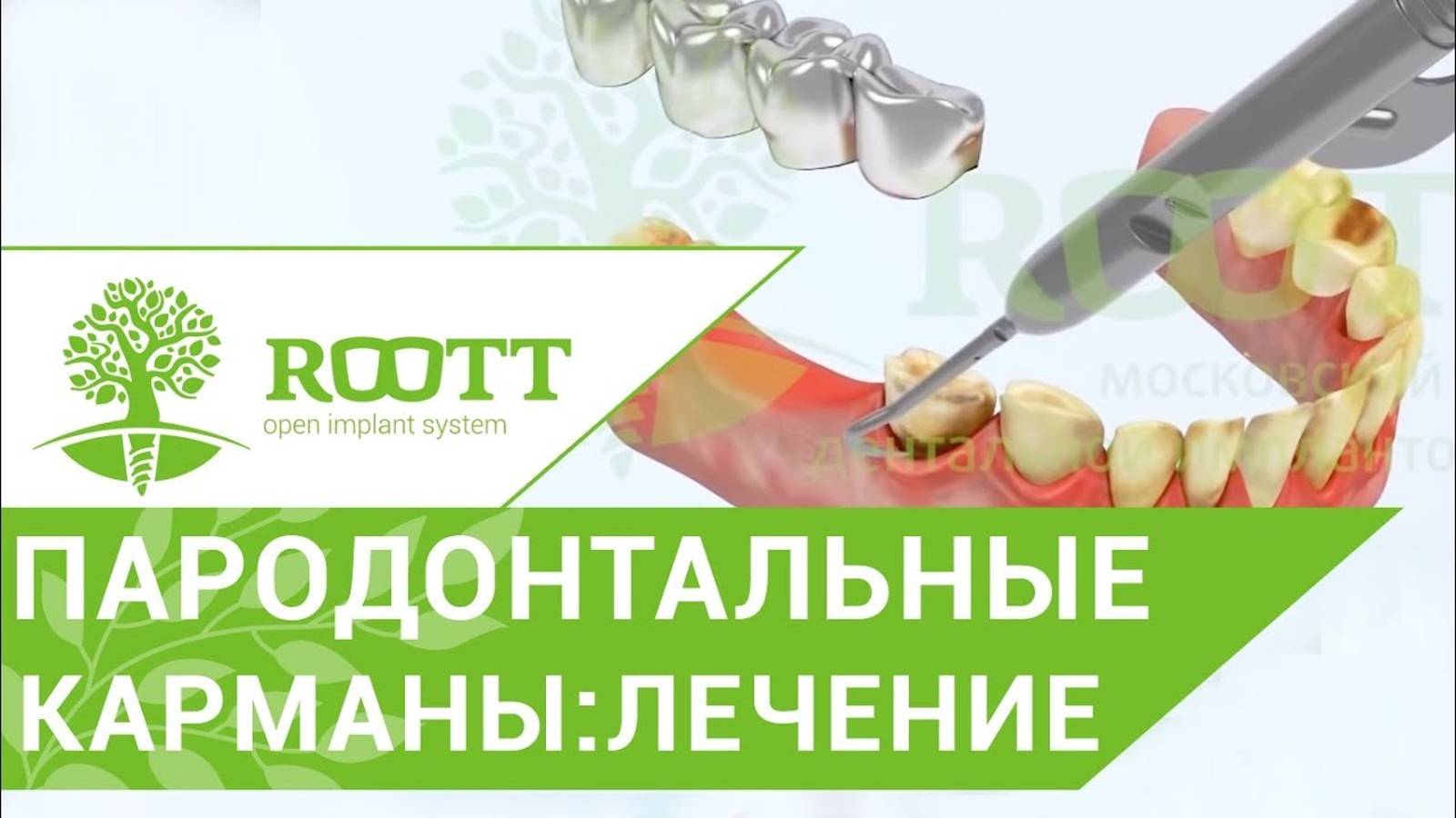 Открытый кюретаж видео 👄 Как происходит операция открытый кюретаж десен в ROOTT