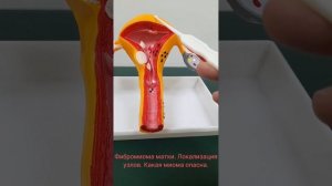 ФИБРОМИОМА  МАТКИ.  КАКАЯ  МИОМА  ОПАСНА.