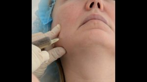 Применение липолитиков в ИПХ Молодею