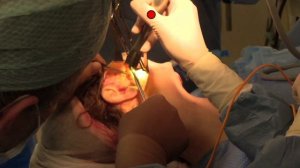 Показательная операция Диссекционный SMAS лифтинг, корсетная платизмопластика, липосакция шеи