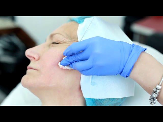 Подтяжка лица мезонитями смотреть онлайн