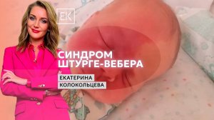 Синдром Штурге–Вебера: правильная постановка диагноза и лечение / Екатерина Колокольцева