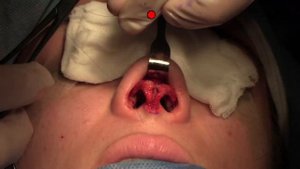 Показательная операция Первичная риносептопластика