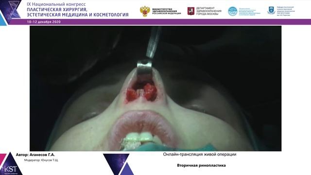 Трансляция живой операции: Вторичная ринопластика