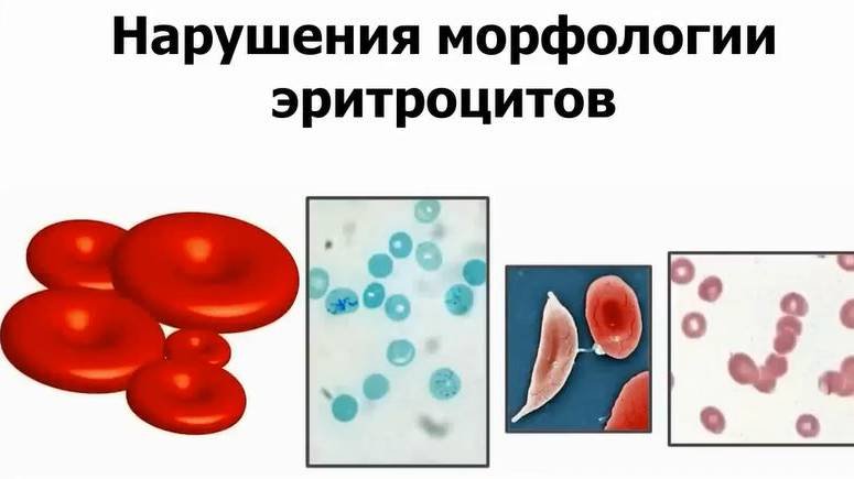 Нарушения морфологии эритроцитов