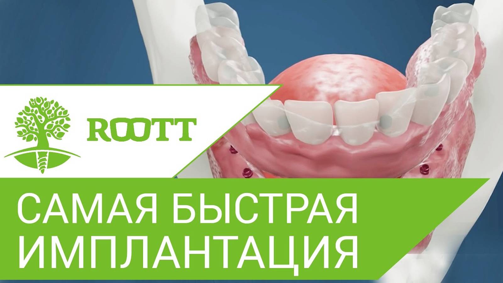 Cамая быстрая имплантация зубов: все на 8 имплантах. All on 8. ROOTT.