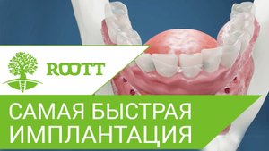 Cамая быстрая имплантация зубов: все на 8 имплантах. All on 8. ROOTT.