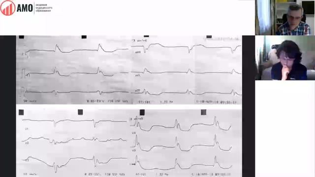 Экг При Неотложных Состояниях смотреть онлайн