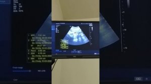 УЗИ 31 неделя скрининг 3