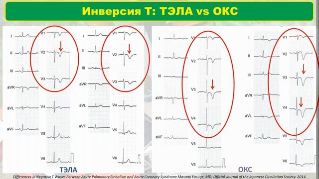 Тэла Под Экг-Маской Острого Коронарного Синдрома смотреть онлайн