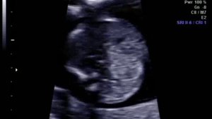 УЗИ 15 недель и 3 дня (часть1)