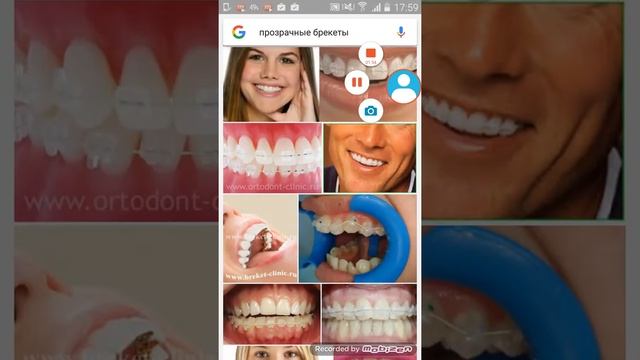 Мне скоро поставят брекеты 😱 смотреть онлайн